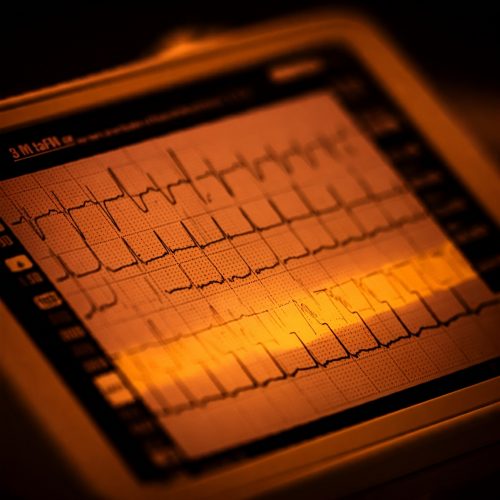 Stenosi Subaortica nel Cane: Un Difetto Cardiaco Congenito